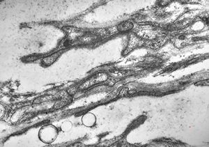 M,15y. | neurinoma fasc. optici M,15y. | neurinoma fasc. optici